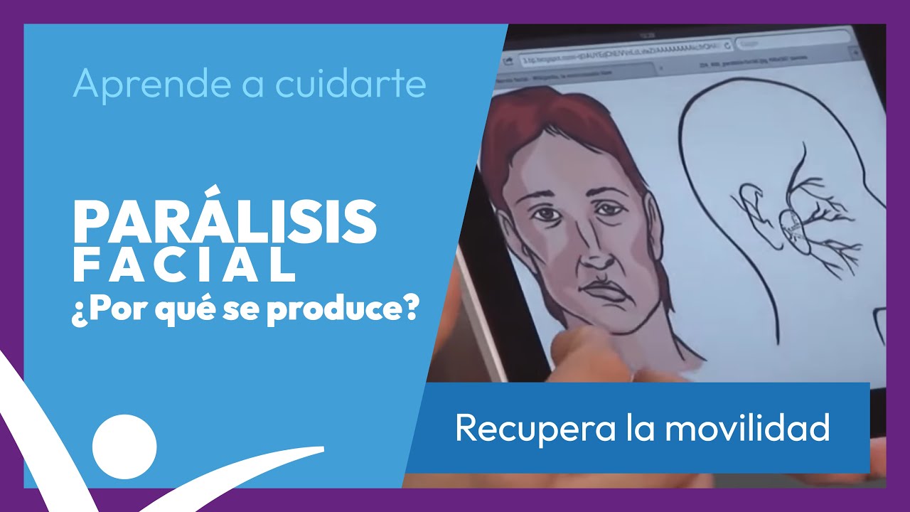 Parálisis Facial. Qué es y tratamiento en la Clínica Javier Navarro