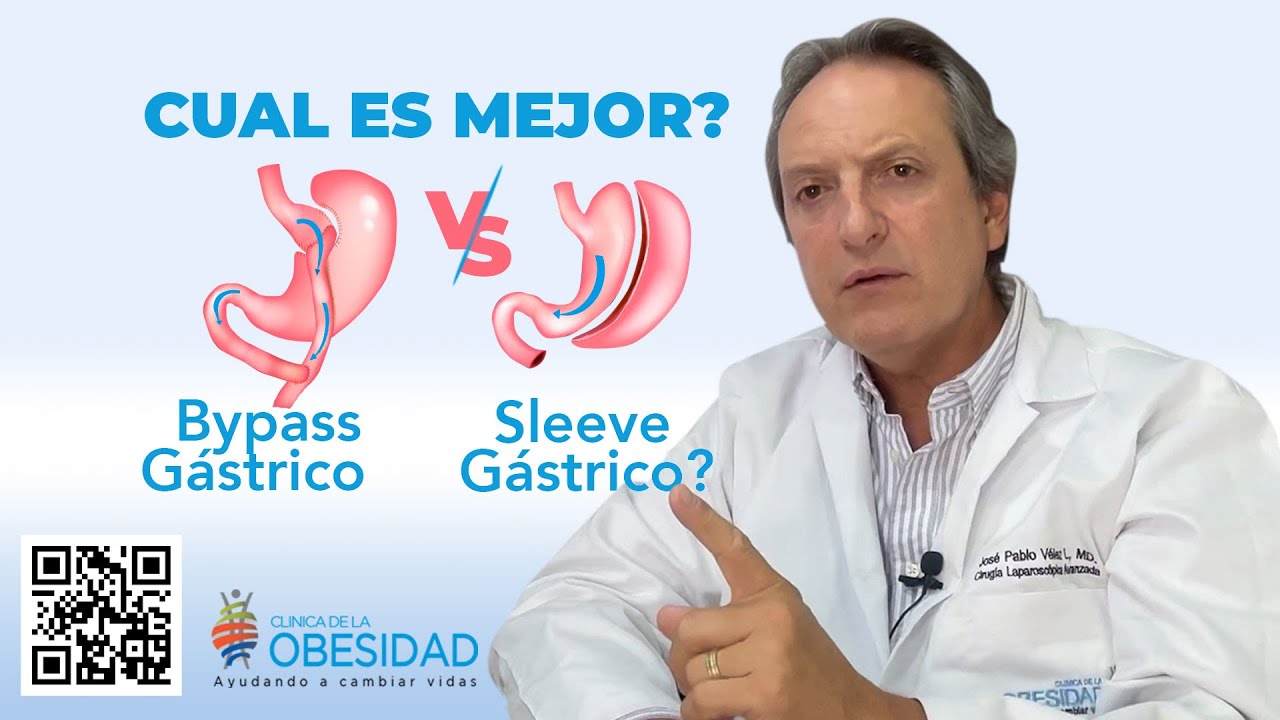 Bypass gástrico o Sleeve gástrico ¿Cual es mejor?