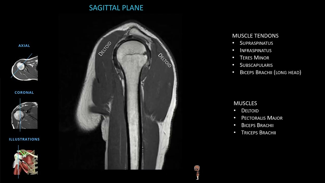 MSK: Shoulder/Arm Radiograph/MRI/Arteriogram Basic Features