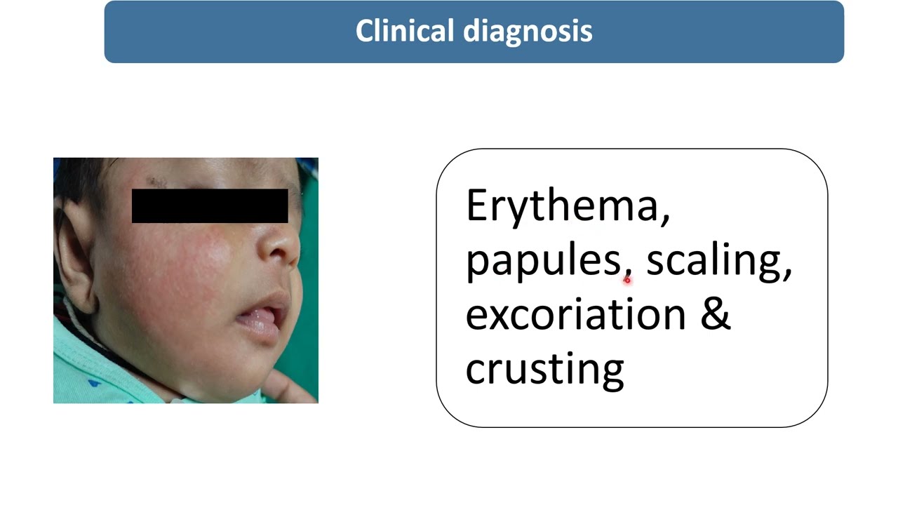 Atopic Dermatitis || Spot Diagnosis - 15 || Pediatrics