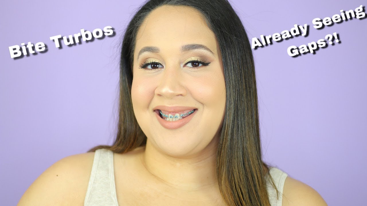 MY FIRST WEEK WITH ADULT BRACES AND BITE TURBOS - UPDATE & PRODUCTS I'VE BEEN USING!