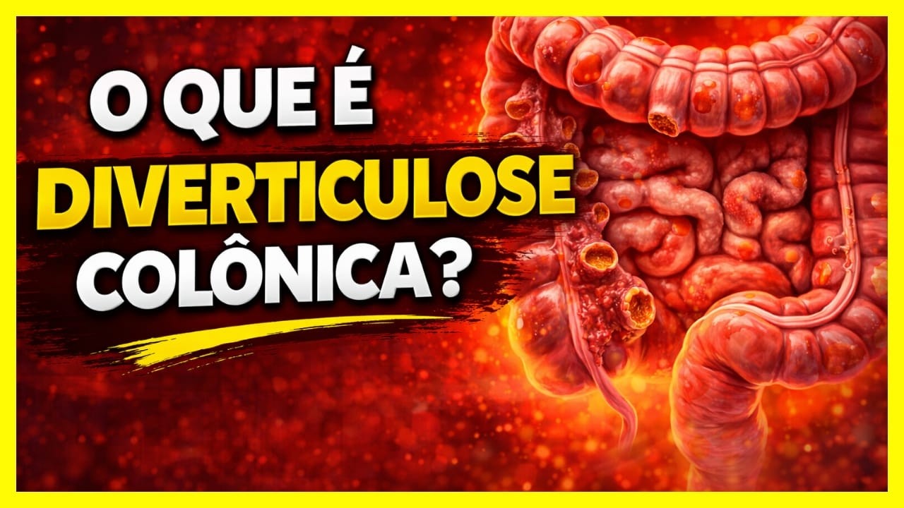CUIDADO: DIVERTICULOSE COL&Ocirc;NICA pode estar no seu intestino! VEJA OS SINAIS #intestinosaud&aacute;vel