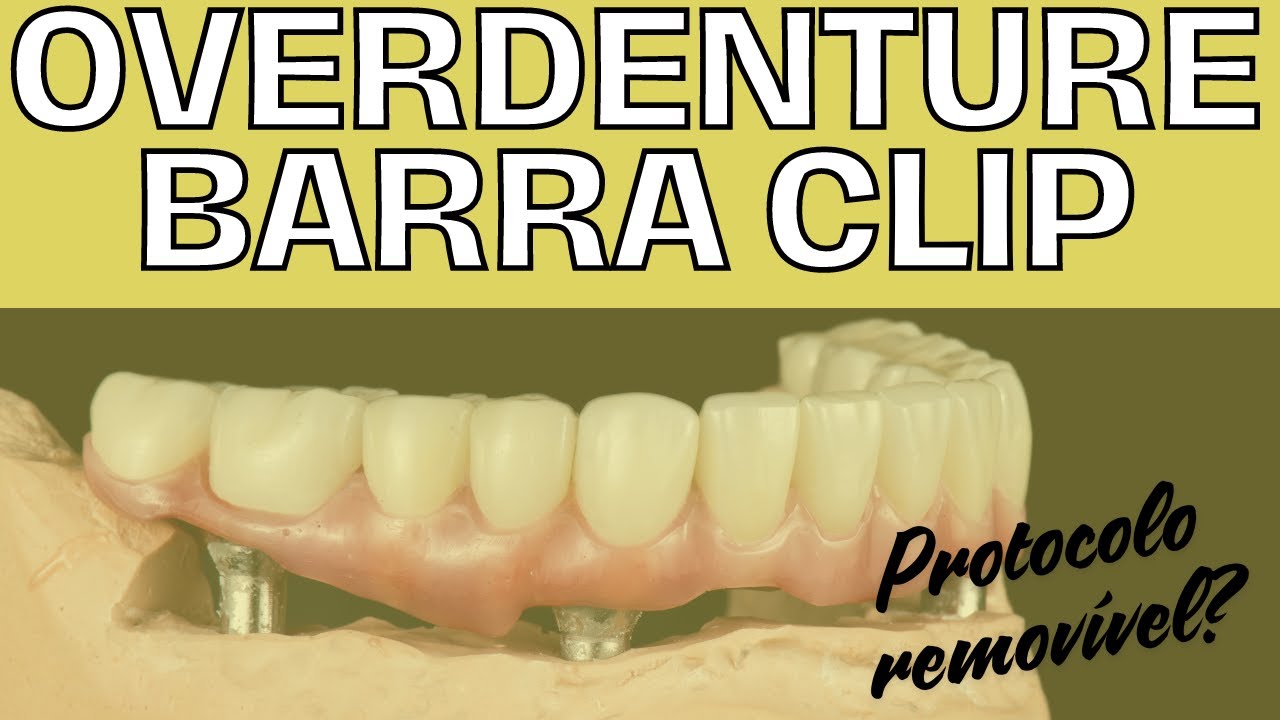 OVERDENTURE BARRA CLIP SOBRE IMPLANTE