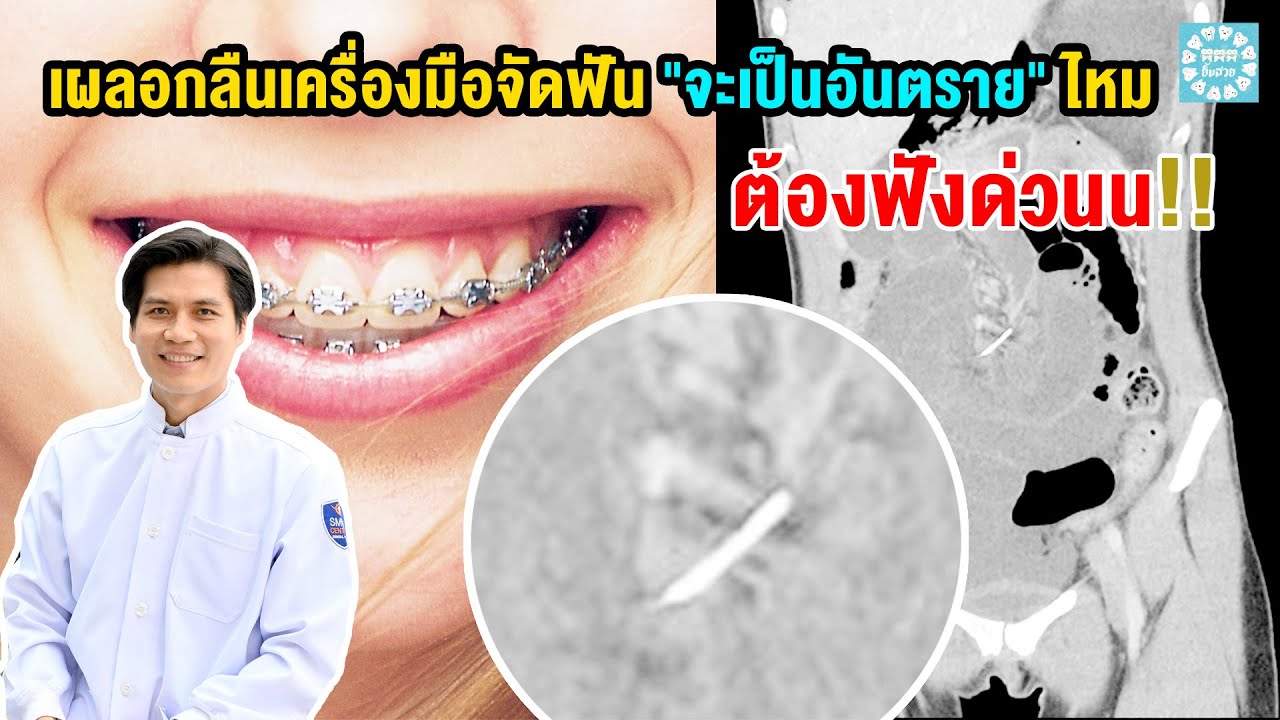 เผลอกลืนเครื่องมือจัดฟัน 