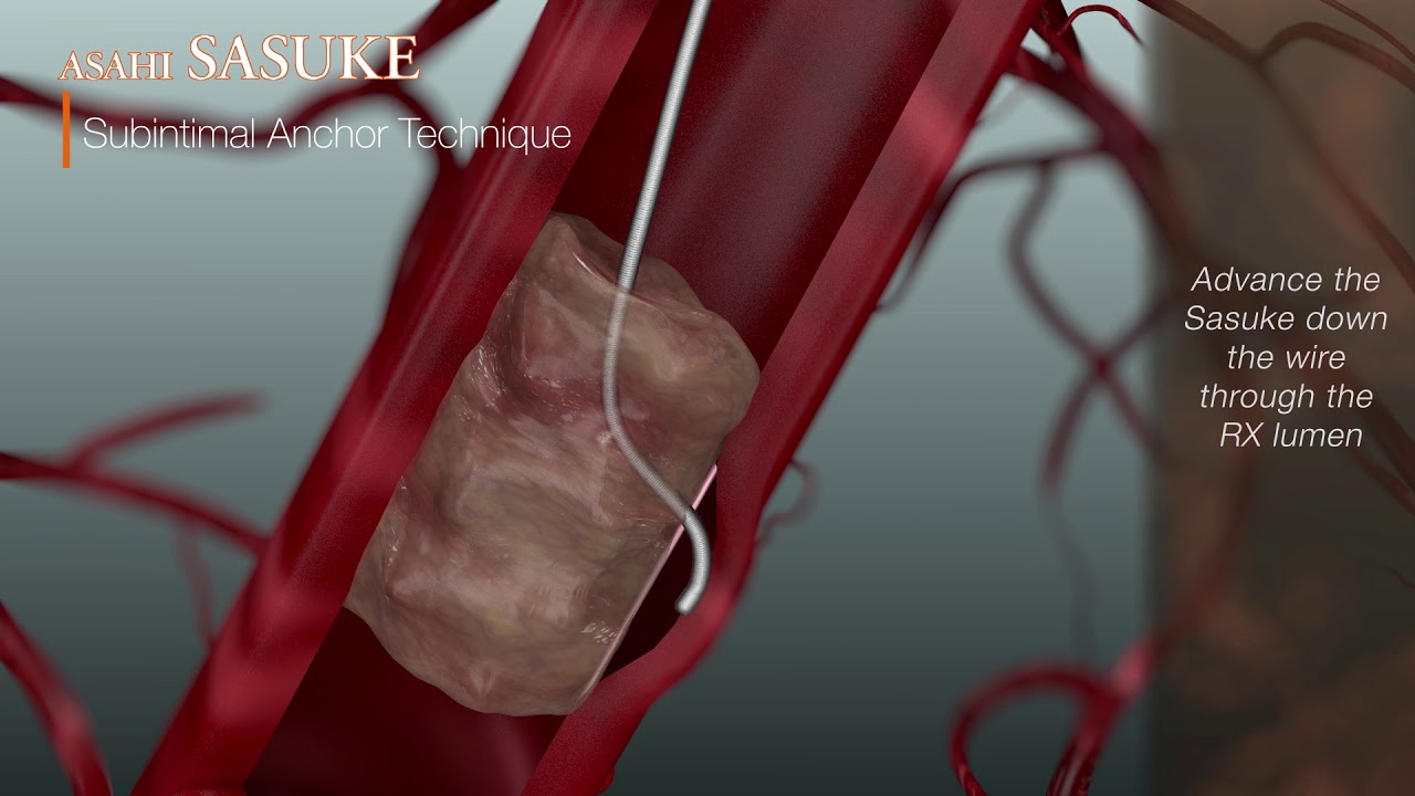 Subintimal Anchor Technique with ASAHI SASUKE Double Lumen Catheter