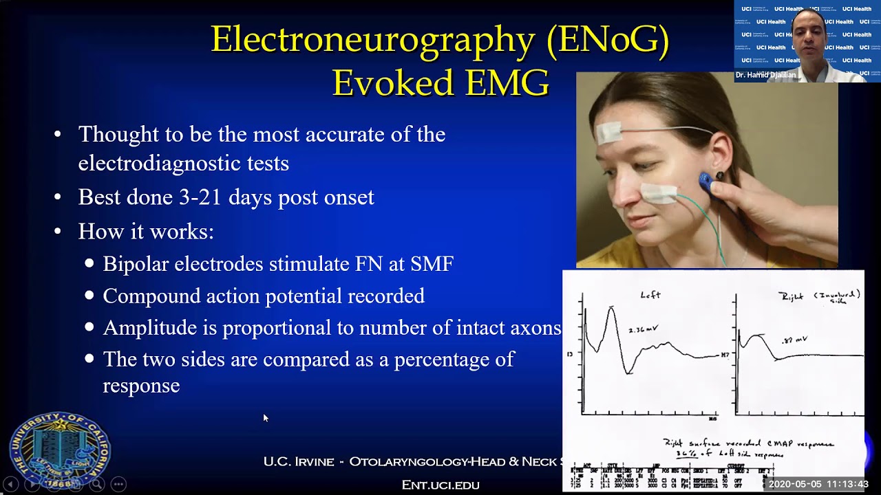 Facial nerve electrical testing - Dr. Hamid Djalilian