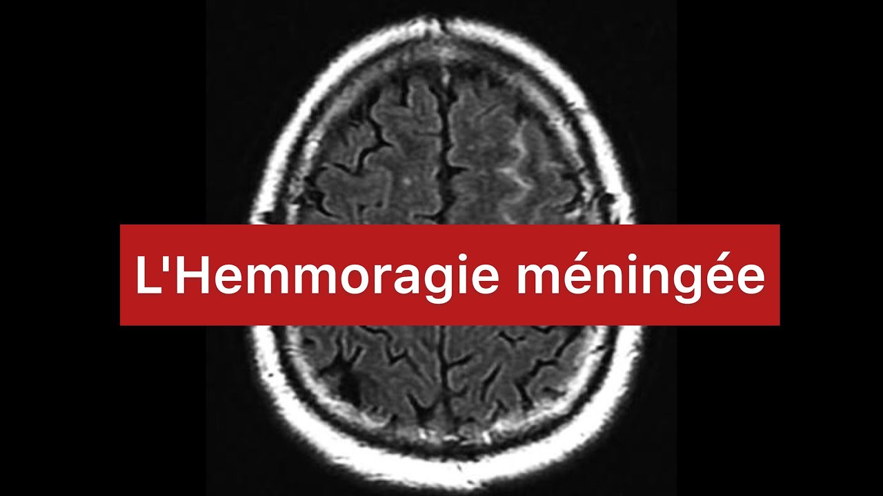 🔻 Comprendre L'Hemmoragie méningée en 40 min ! | Neurologie | 4ème année medecine