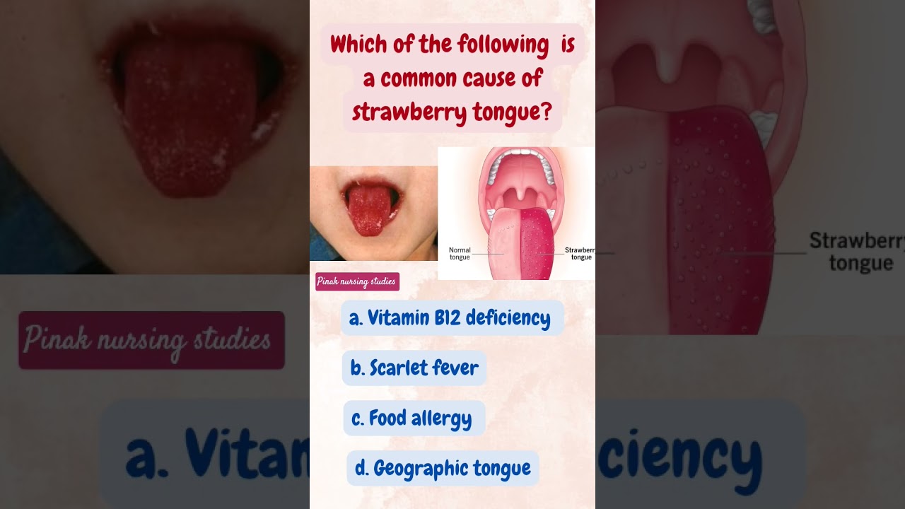 Strawberry tongue is most commonly seen in:  scarlet fever, Kawasaki disease, toxic shock syndrome