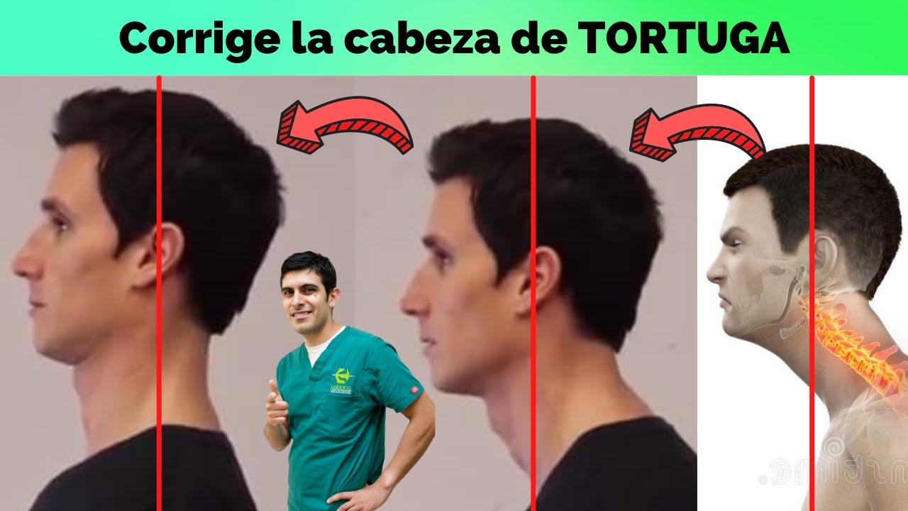 CABEZA DE TORTUGA / Cómo corregir la CABEZA ADELANTADA CON 1 UNA RUTINA