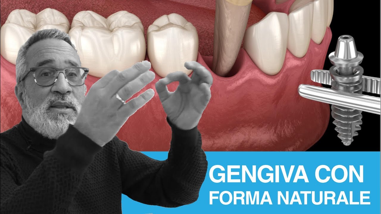 Impianto dentale: cosa succede alla gengiva