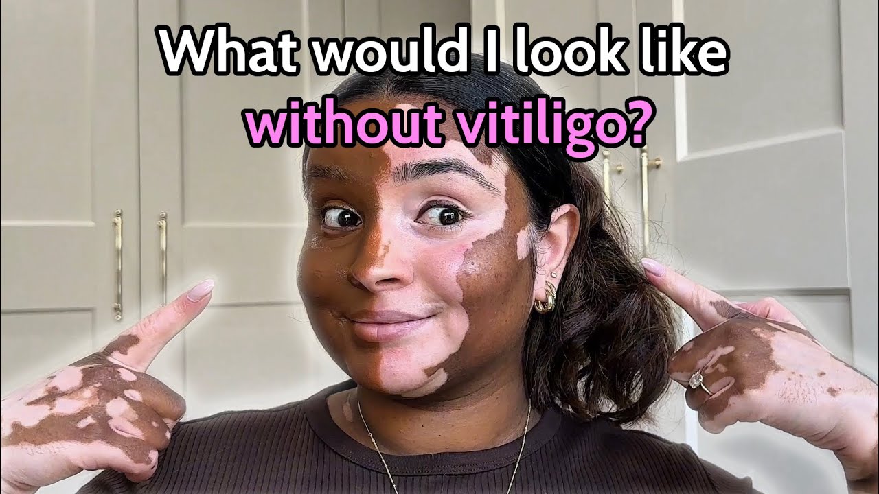 I Tried Vitiligo Makeup For The First Time!