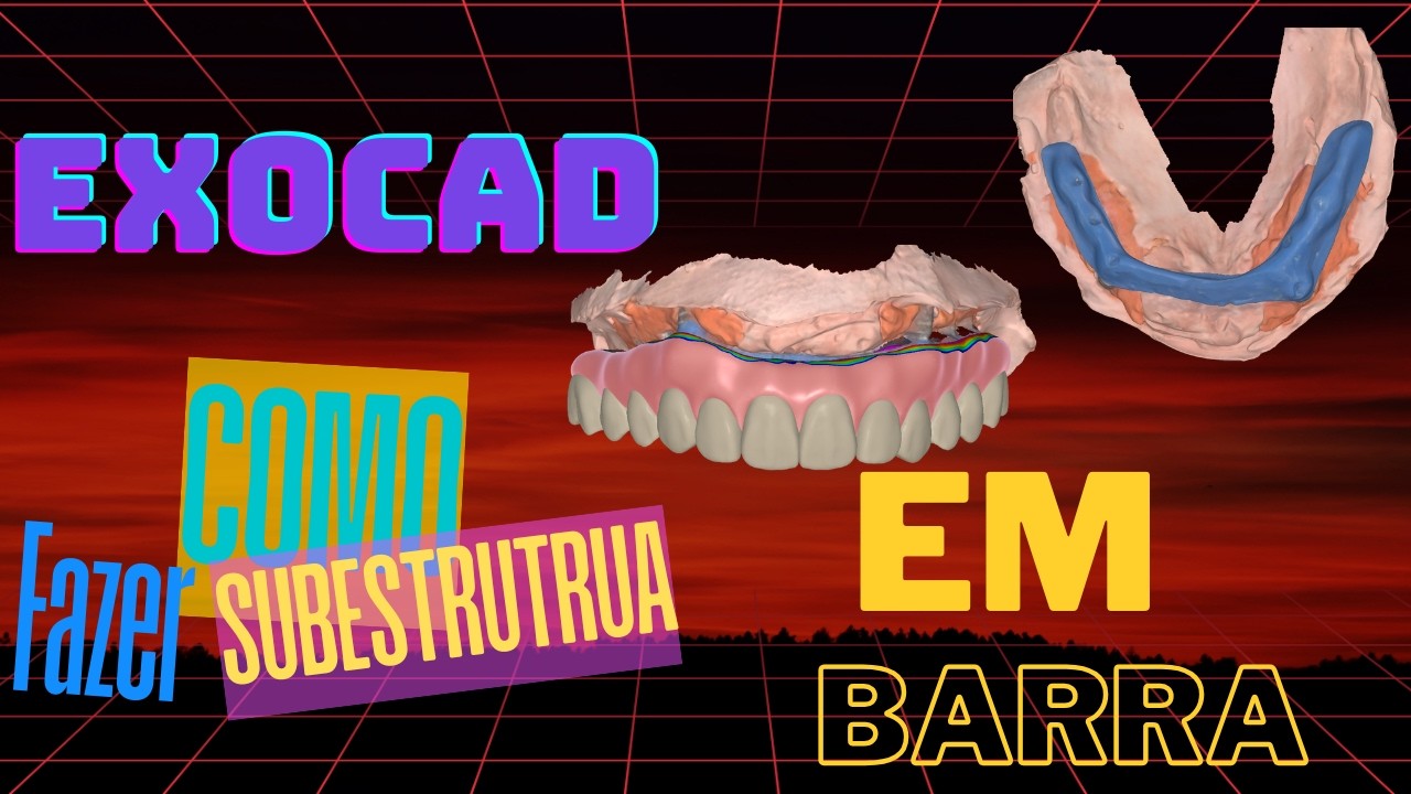 EXOCAD- COMO FAZER UMA SUBESTRUTURA POR CIMA DA BARRA