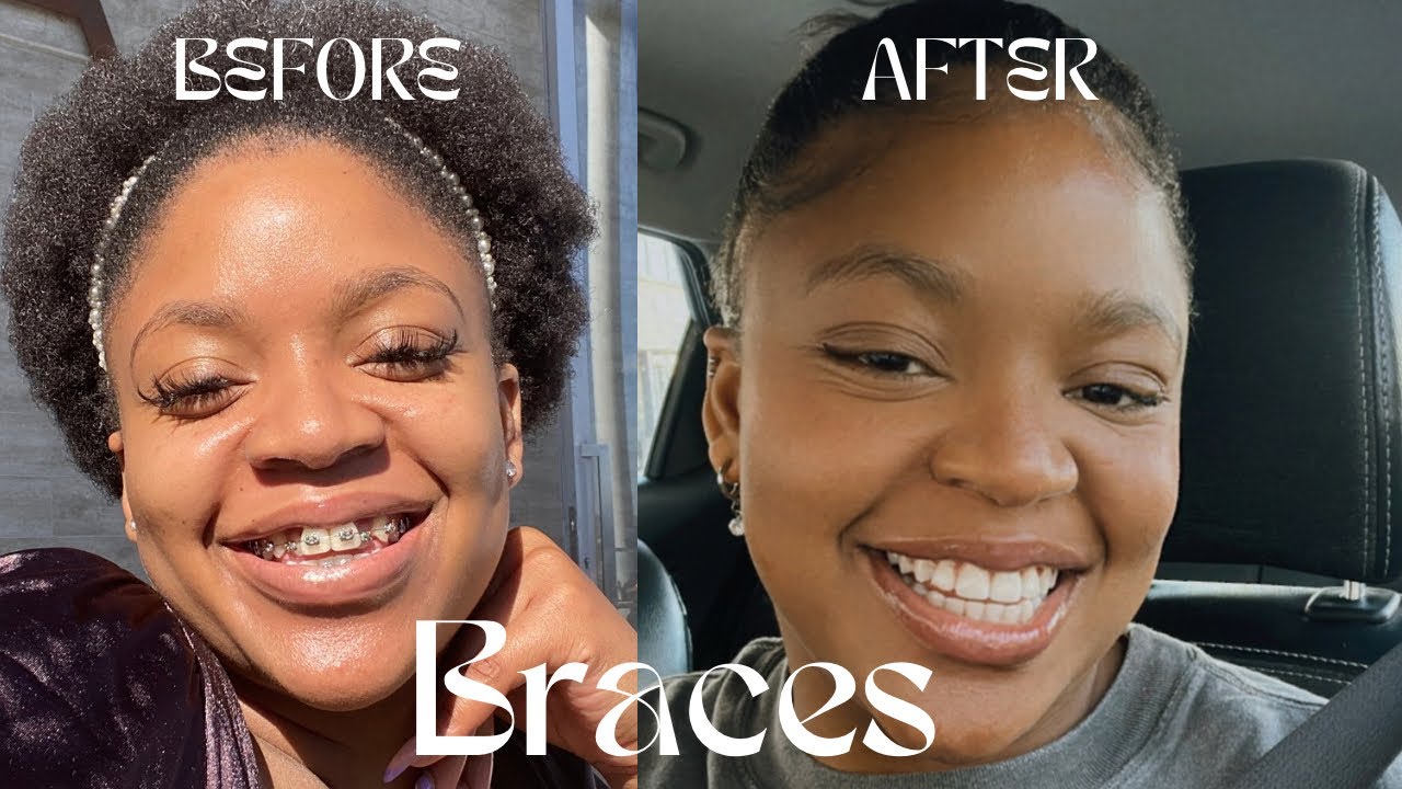Braces Journey Before & After | Getting My Braces Off Transformation