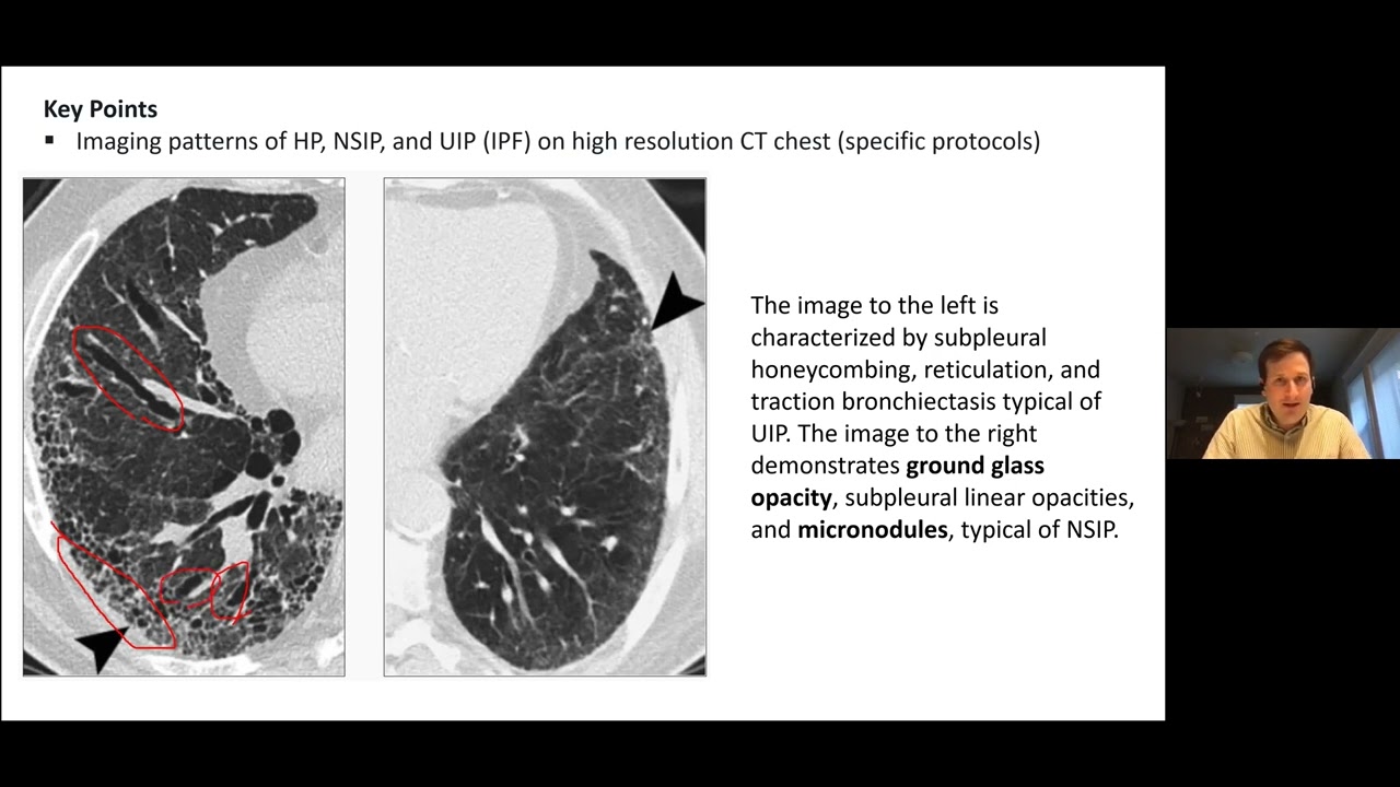 AHD MKSAP Pulm and Sleep K He and T Keller