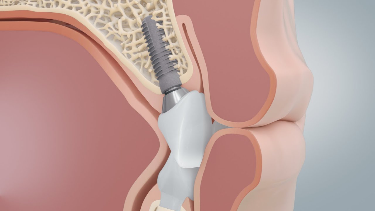 Dental Implants vs Bridges for Missing Teeth (3D-Animation)