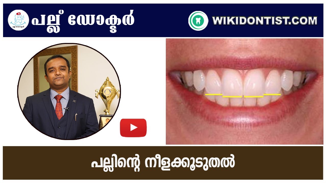 പല്ലിന്റെ നീളകൂടുതൽ...l Malayalam Dental Videos l #Shorts