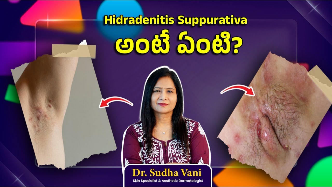 Hidradenitis Suppurativa: Everything You Need to Know | Expert Advice from Dr. Sudhavani