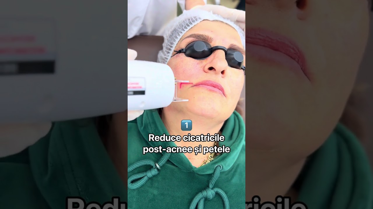 Cicatrici post-acnee? Riduri? Piele lipsită de fermitate? 🔥  Laserul CO2