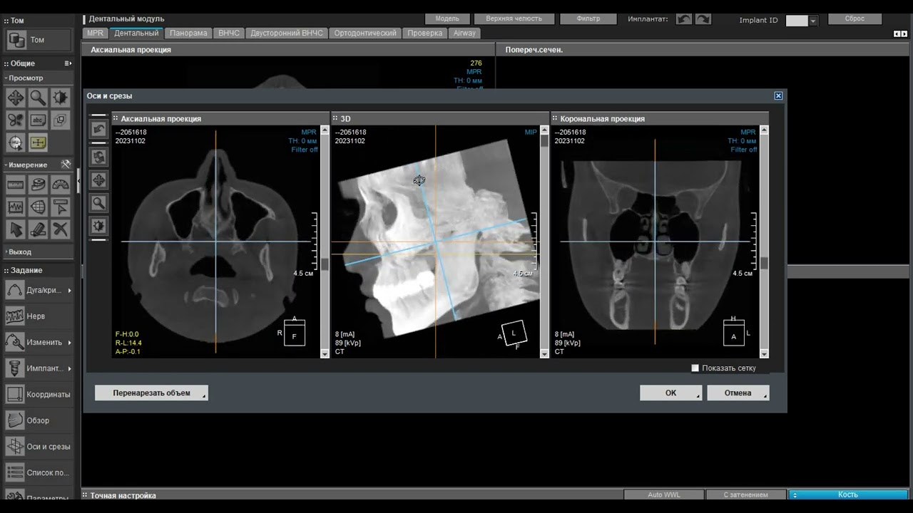 OnDemand 3D Dental from cbct  to panoramic view. Делаем из клкт в панормный вид