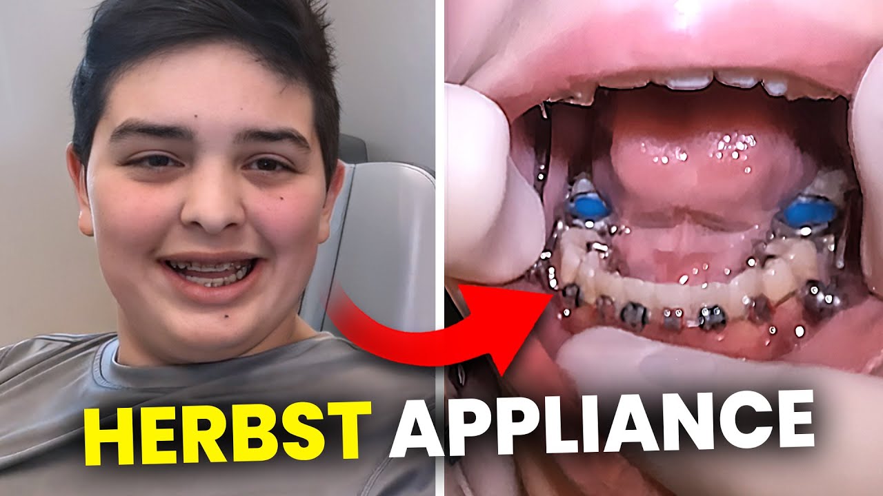 Getting a HERBST APPLIANCE for an overjet&hellip; [McKinney Orthodontist explains]
