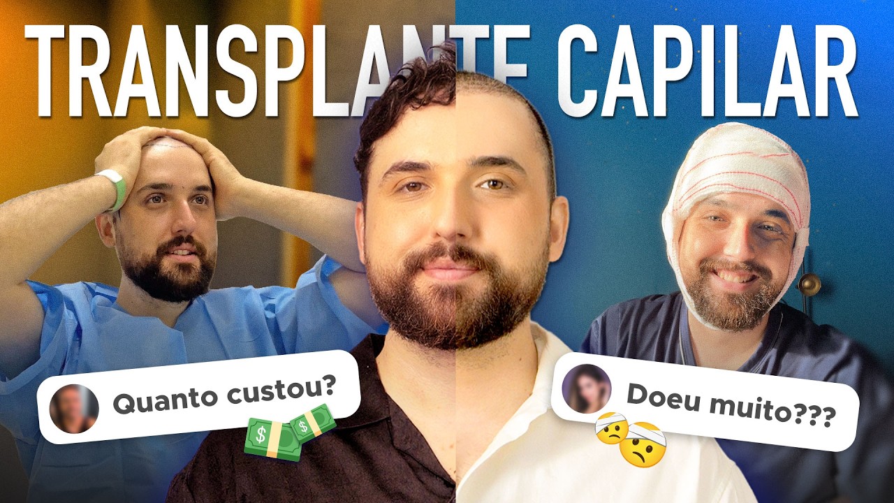 QUANTO CUSTA um Transplante Capilar? | Respondendo dúvidas dos inscritos