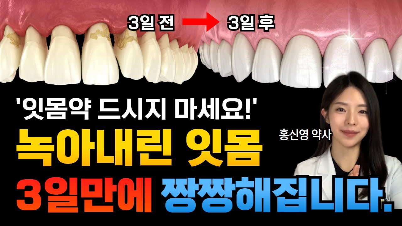 잇몸약, 잇몸영양제 드시지 마세요! 녹아내린 잇몸 3일만에 짱짱해집니다. 약국에서 3천원으로 잇몸 재생하는 방법