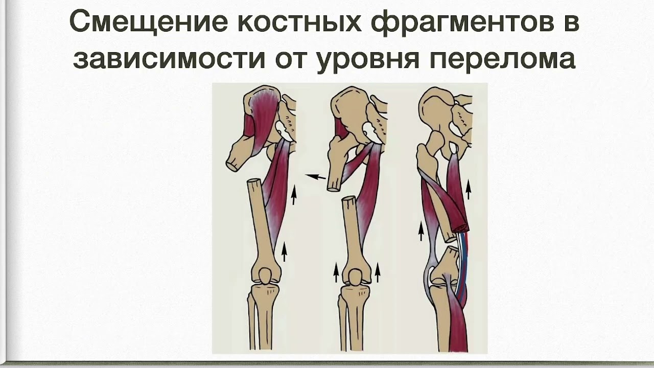32. Переломы диафиза бедренной кости. Клиника, диагностика, лечение