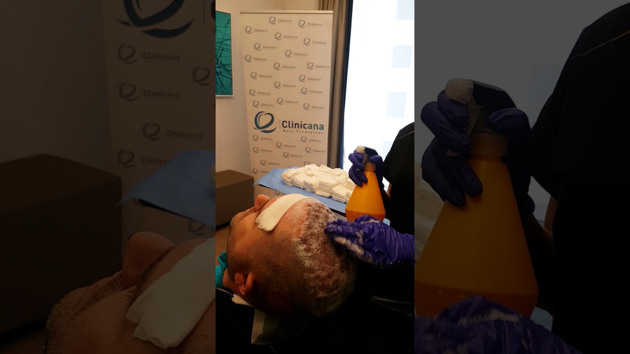 Entretien des cheveux apres une greffe de cheveux