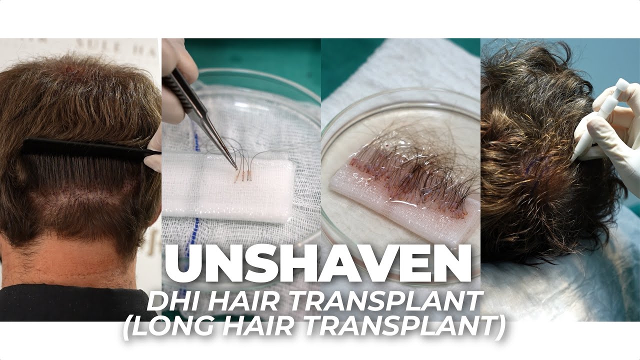 Unshaven DHI Hair Transplant (Long Hair Transplant)