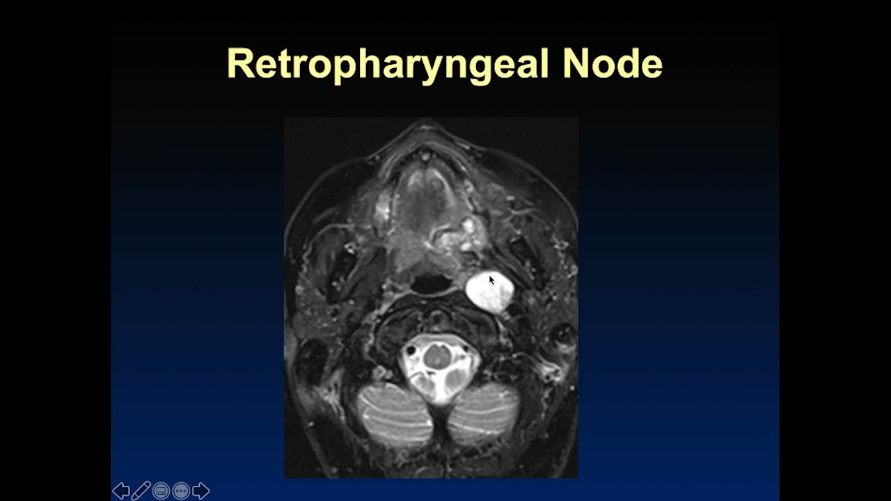 Imaging of Cervical lymphnodes