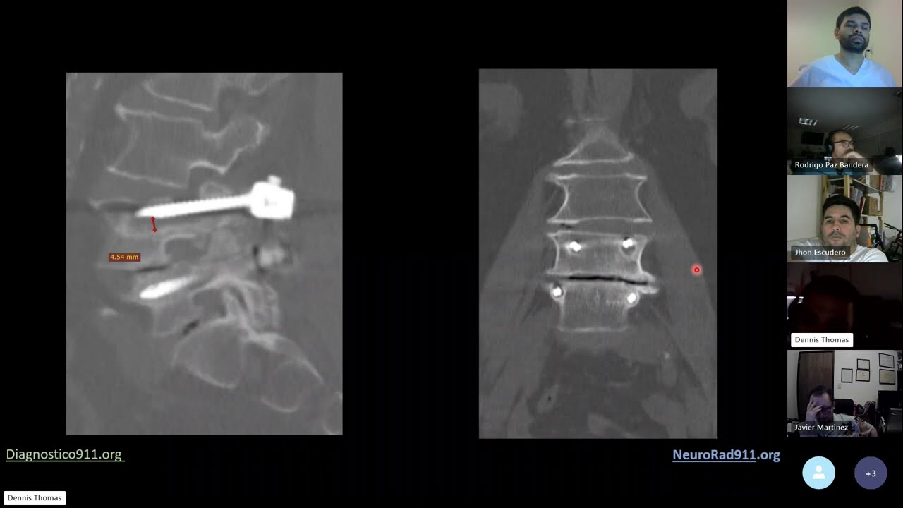 Artrodesis Lumbar ; Evaluaicon de Complicaciones