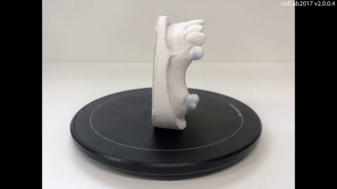41 Partial denture framework
