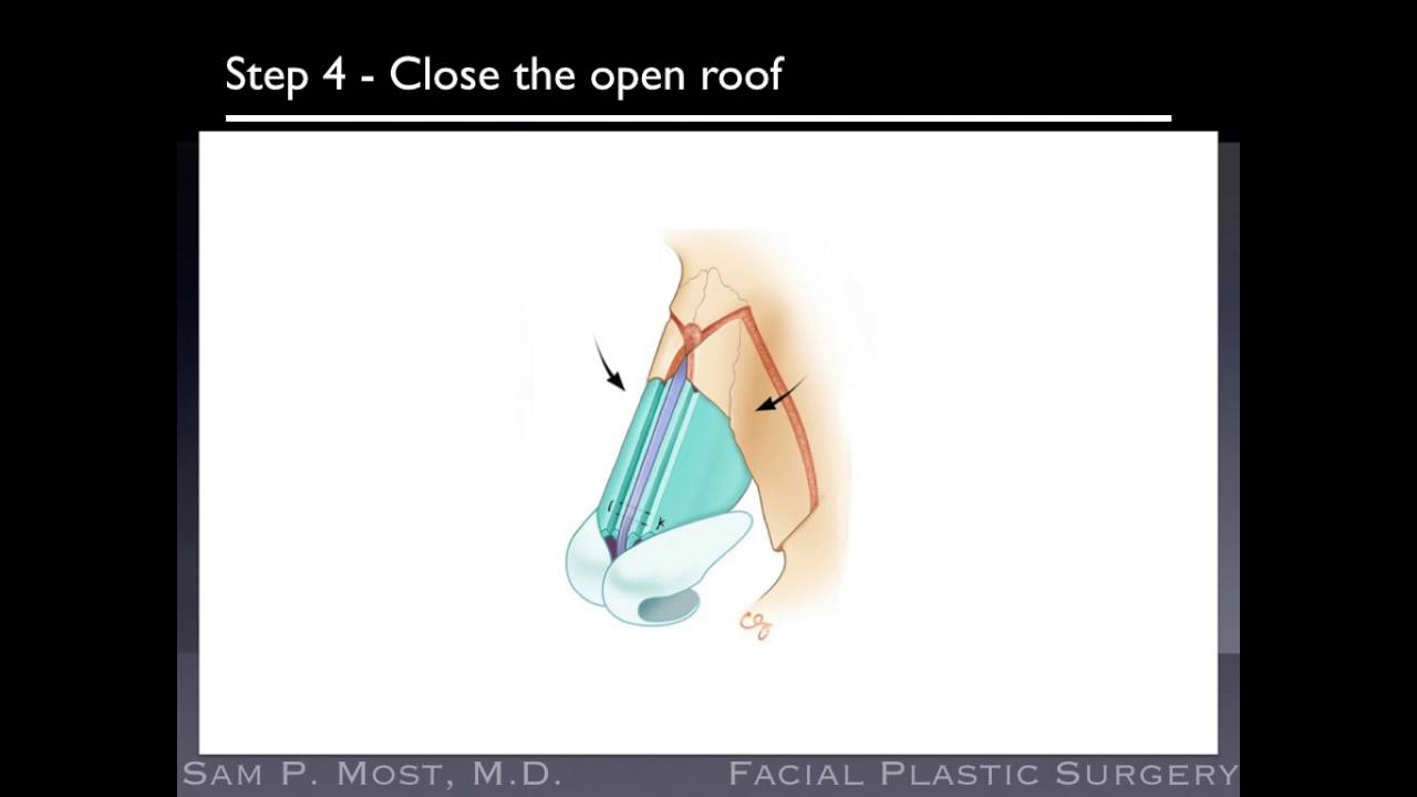 Rhinoplasty: Dorsal Hump Reduction