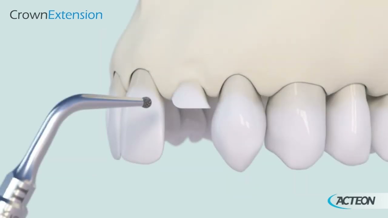 TUTORIAL Crown extension 3D 2023 - Surgery tips - Equipment - Acteon Group