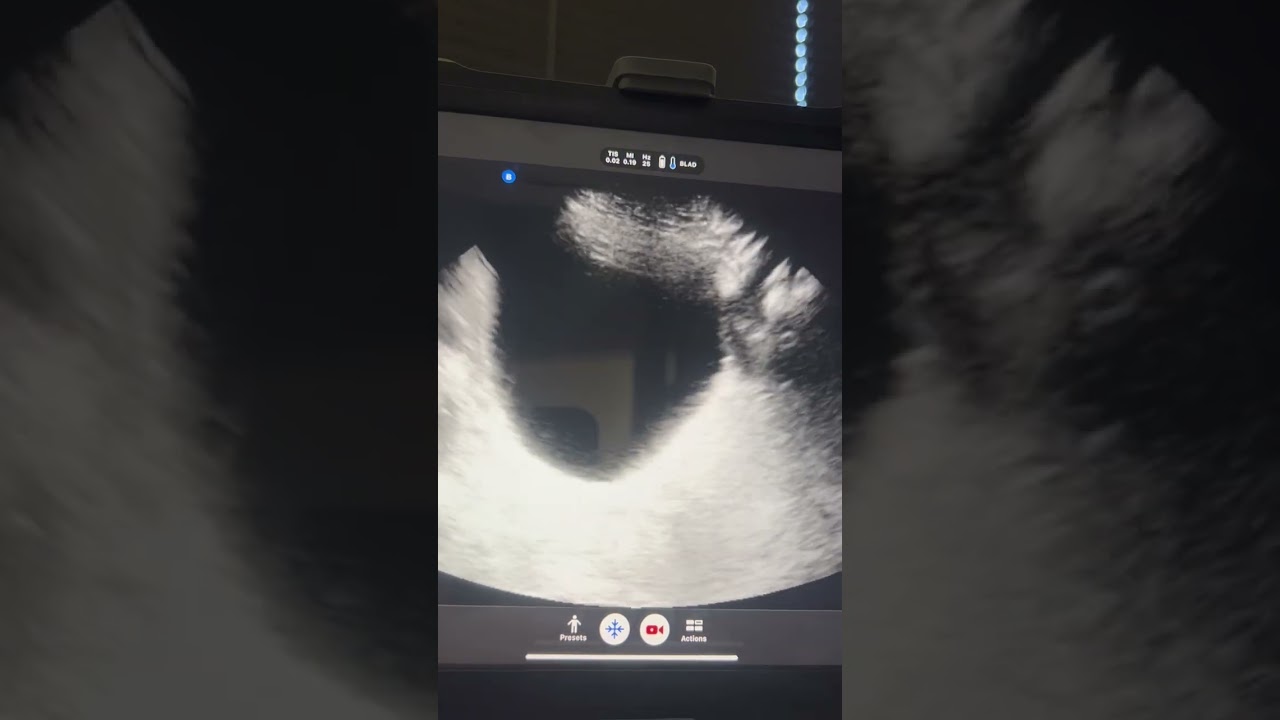 Rehabilitative Ultrasound Imaging to View the Bladder