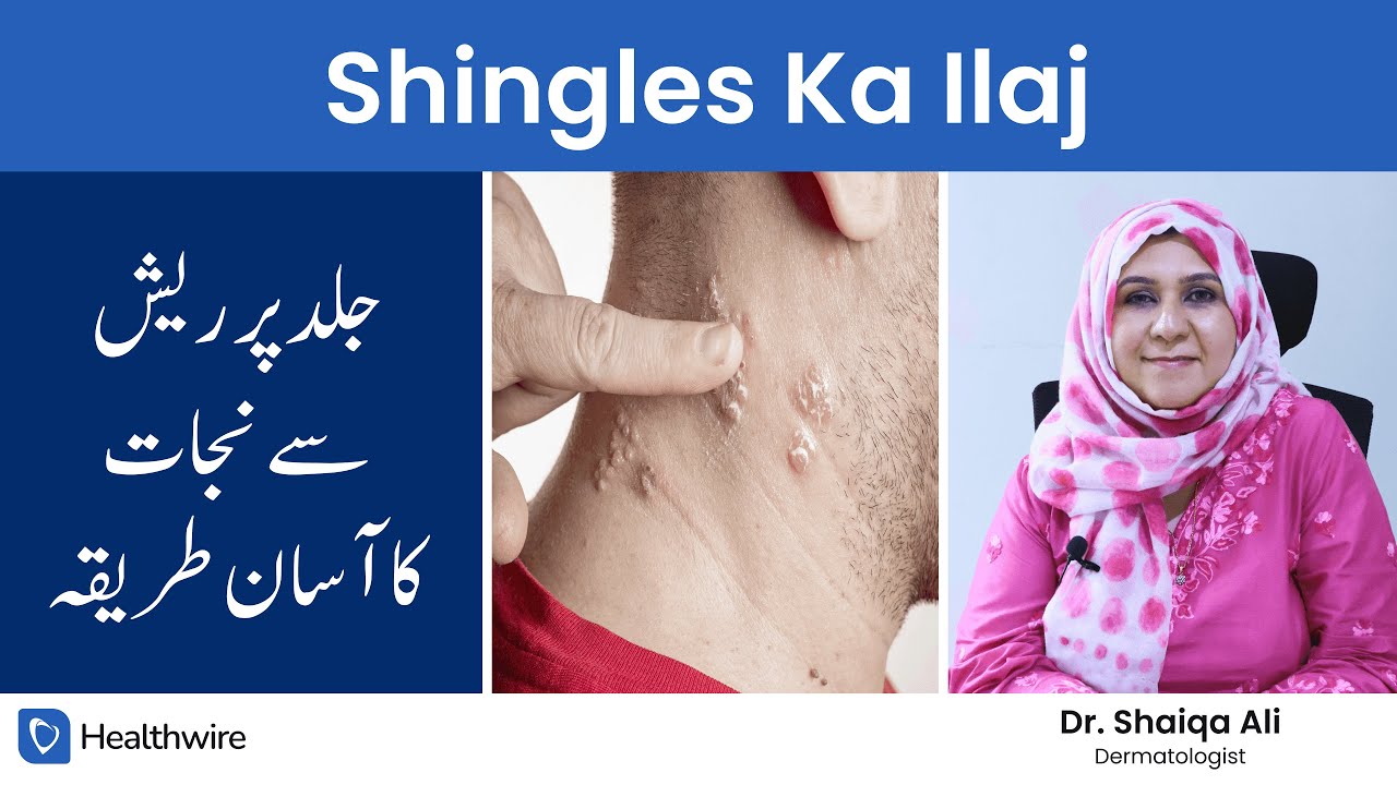Shingles Ka Ilaj – Shingles Treatment in Urdu/Hindi