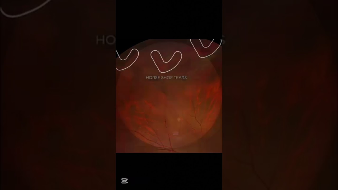 SUBCLINICAL RETINAL DETACHMENT #eyecare #retinopathy #AMD #glaucoma #optometrist #eyedisease