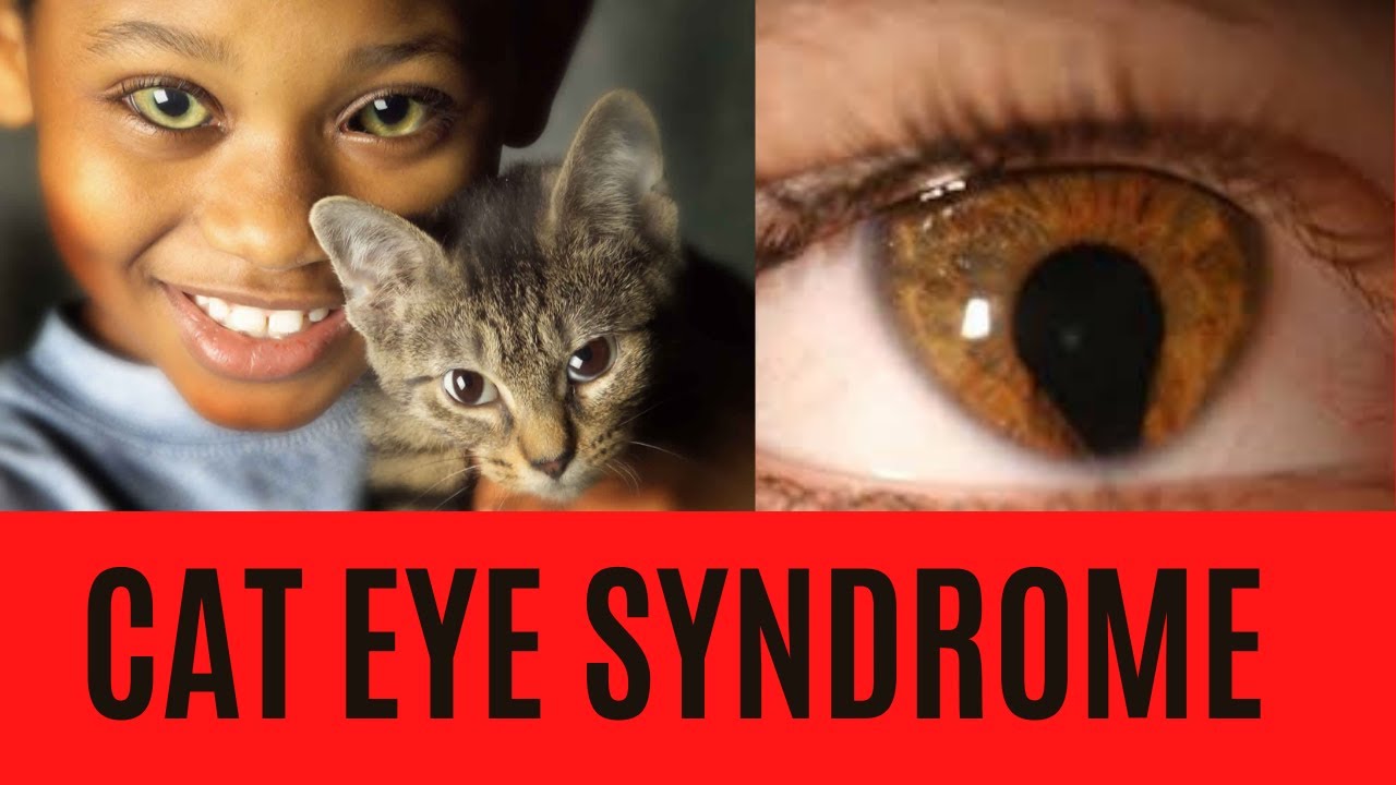 CAT EYE SYNDROME: Summary-Symptoms-Signs-Causes-Treatment-Diagnosis-Prognosis
