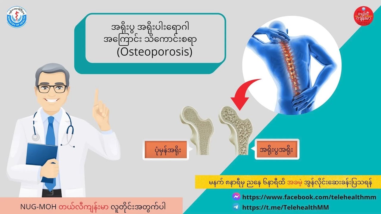 အရိုးပွ အရိုးပါးရောဂါ (Osteoporosis) ရောဂါအကြောင်း သိကောင်းစရာ