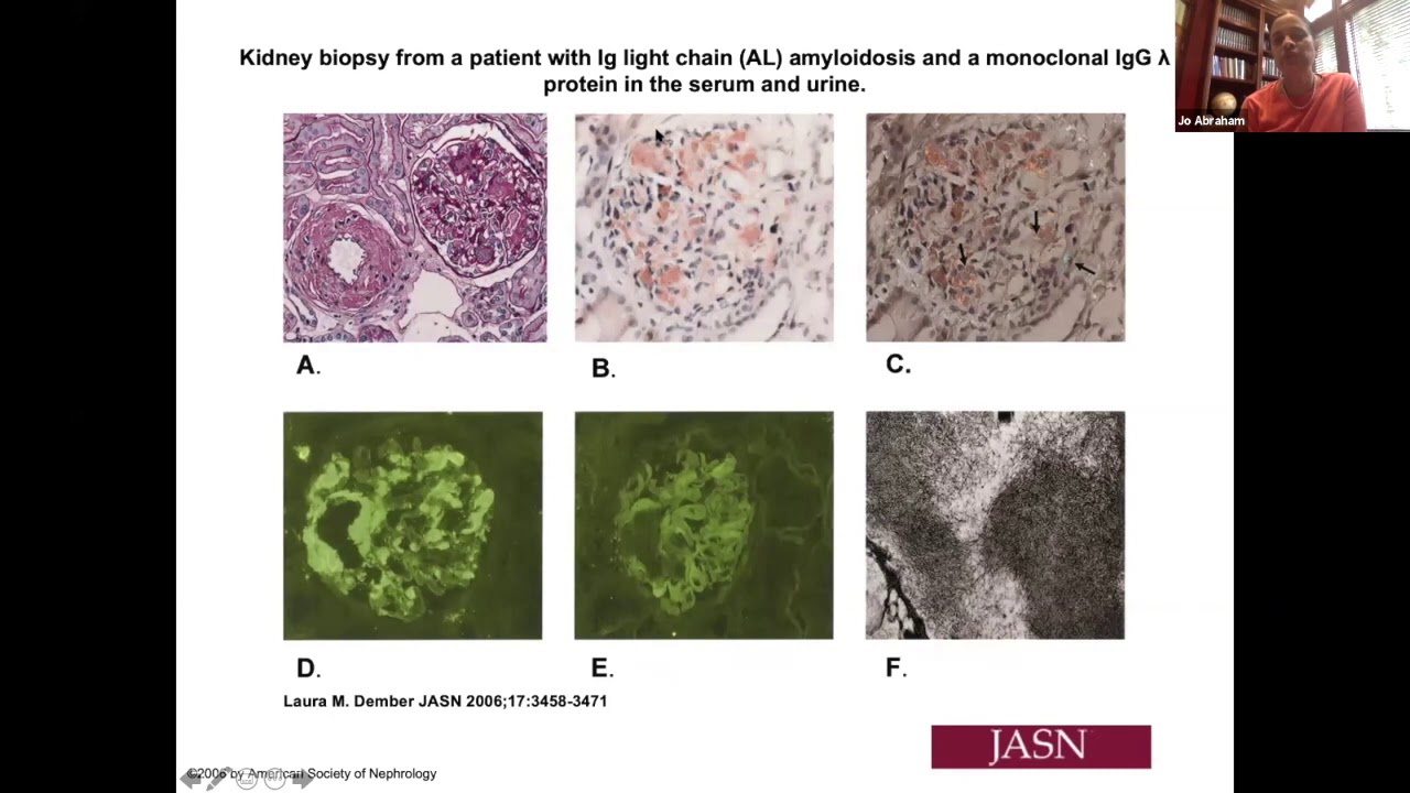 Renal Amyloidosis by Dr. Jo Abraham
