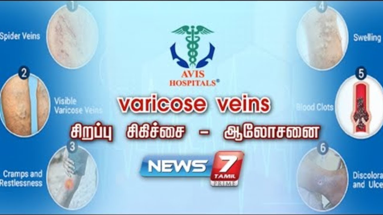 வெரிகோஸ் வெயின் என்றால் என்ன? | News7Tamil | Doctor | AVIS Hospital | Varicose veins