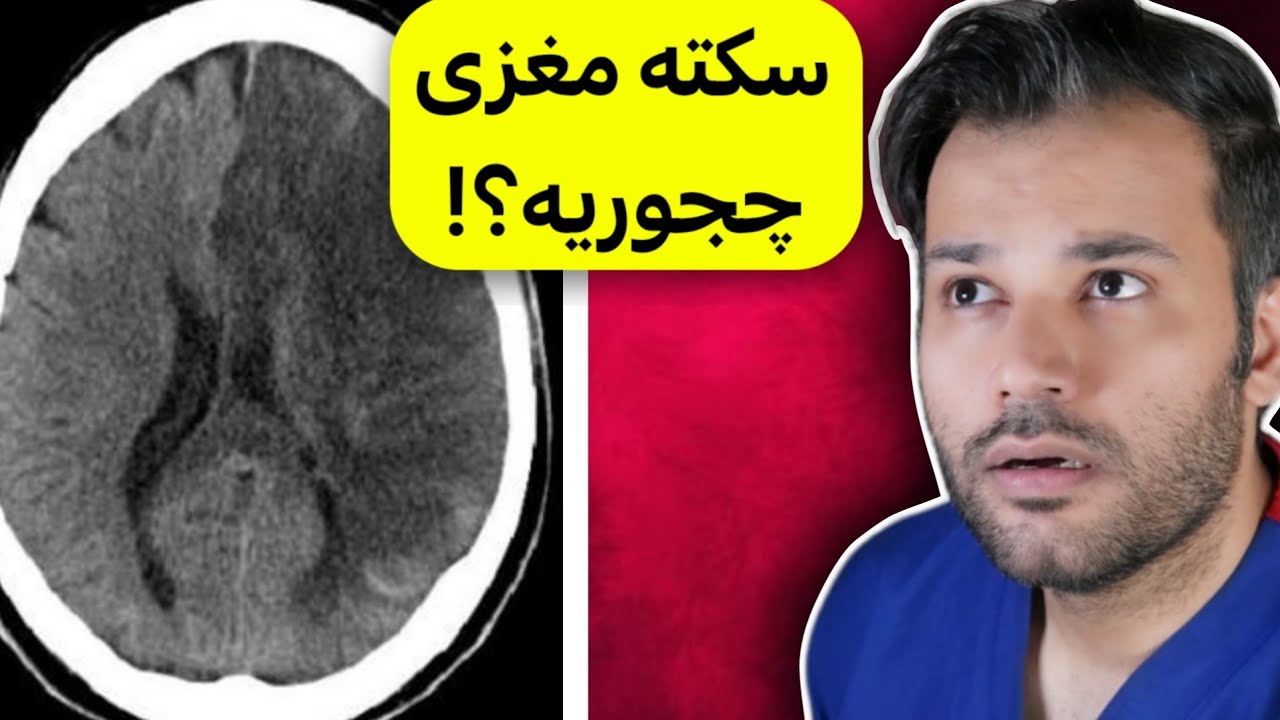 هشدار | سردرد ناگهانی میتونه علامت سکته مغزی باشه!