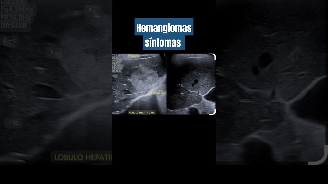 Hemangioma hep&aacute;tico s&iacute;ntomas