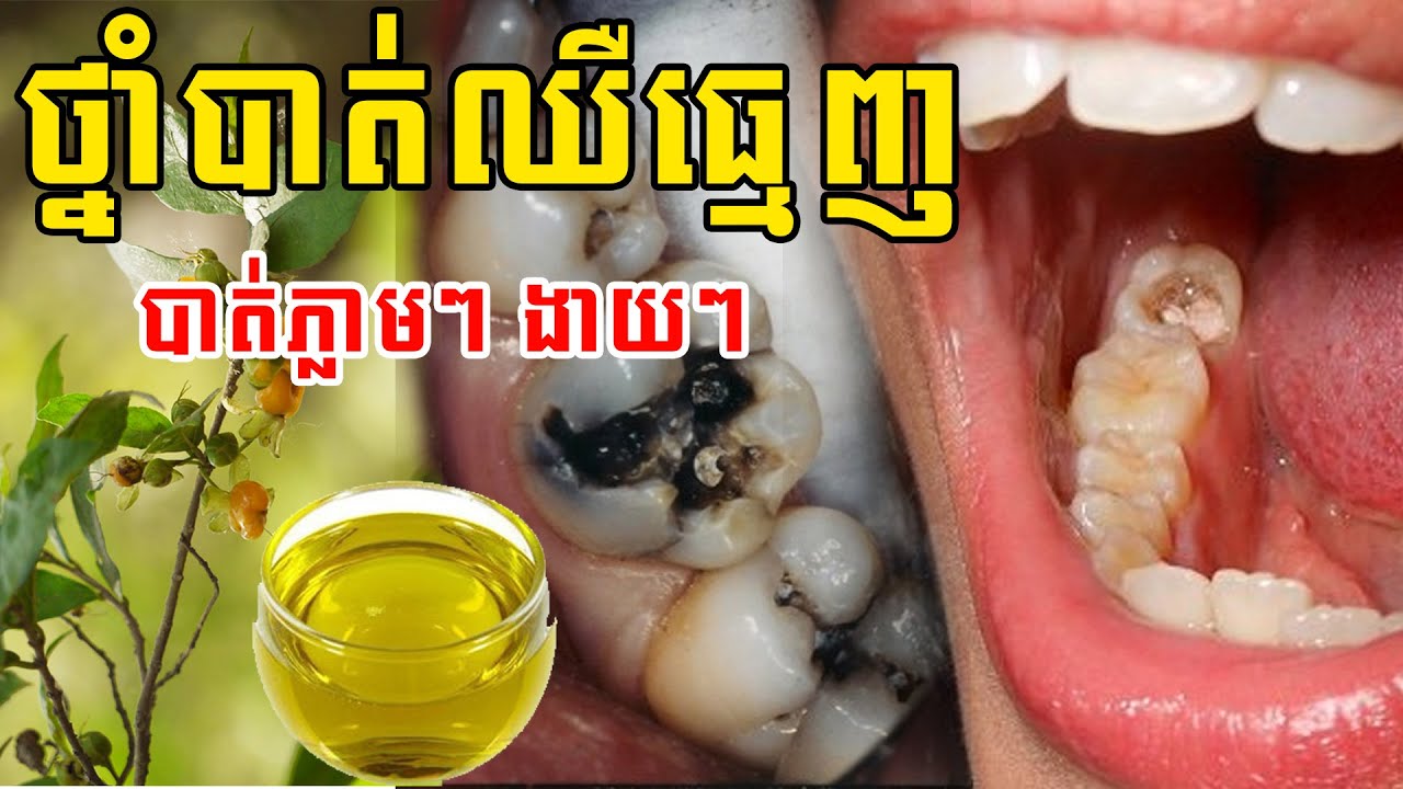 ថ្នាំបាត់ឈឺធ្មេញ _Toothache Khmer traditional treatment 100% Effective [[ គ្រូខ្មែរ-ថ្នាំខ្មែរ ]]