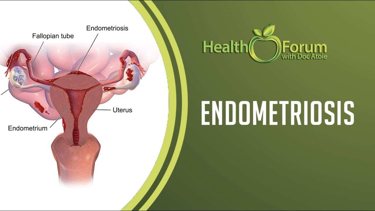 21 January 2020 | Word of the Day: Endometriosis