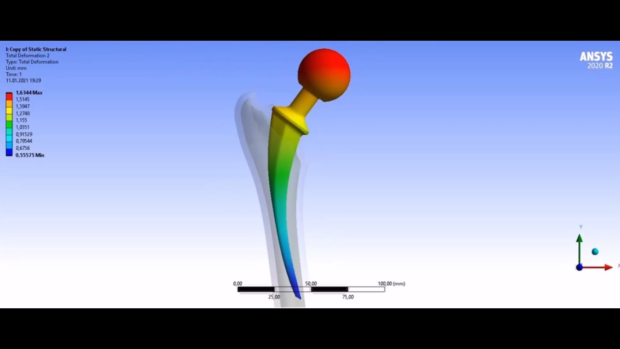 Hip prosthesis