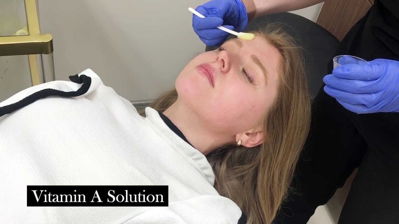 Best Peel for Pigment, Sun Damage + Melasma | Nashville Licensed Esthetician