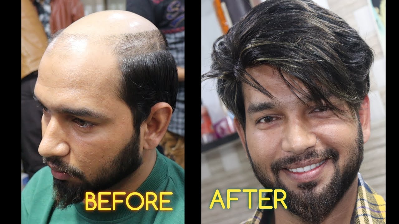 HAIR PATCH SERVICE & WINTER CARE CONTACT-(9711944387)||PRINCE KING HAIR!