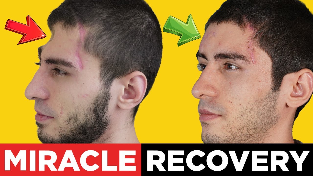 Skull Reconstruction After Car Crash | Patient Recovery Story in Istanbul, Turkey