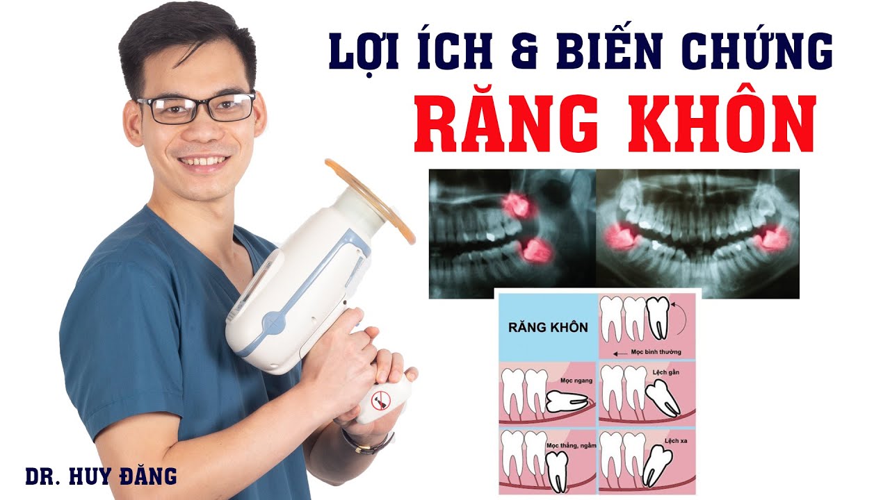 Tại sao phải nhổ răng khôn? Khi nào thì cần phải nhổ?